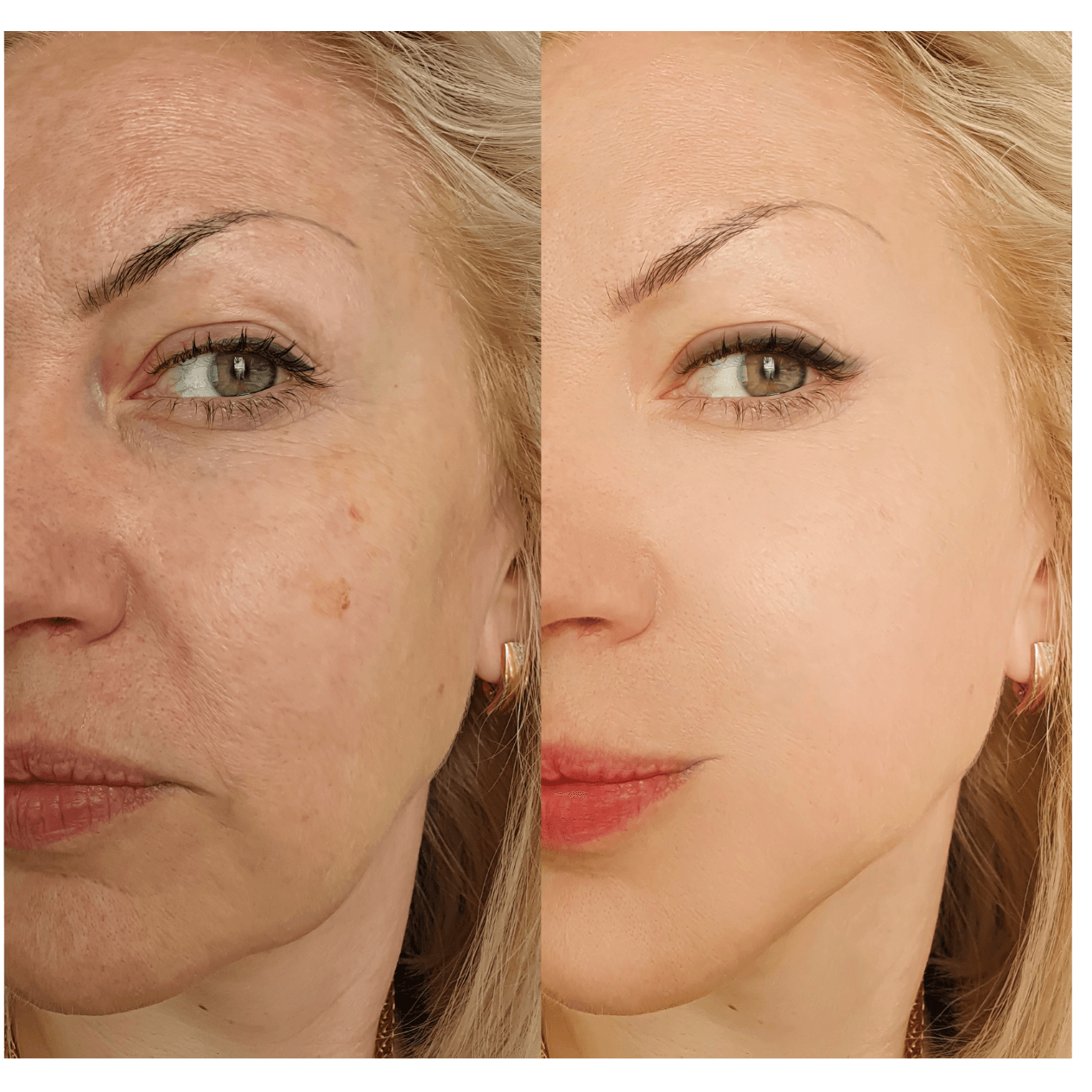 Laser Resurfacing Before & Aft